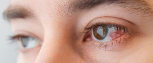 person with redness in eye