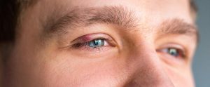 person with red stye in their eye