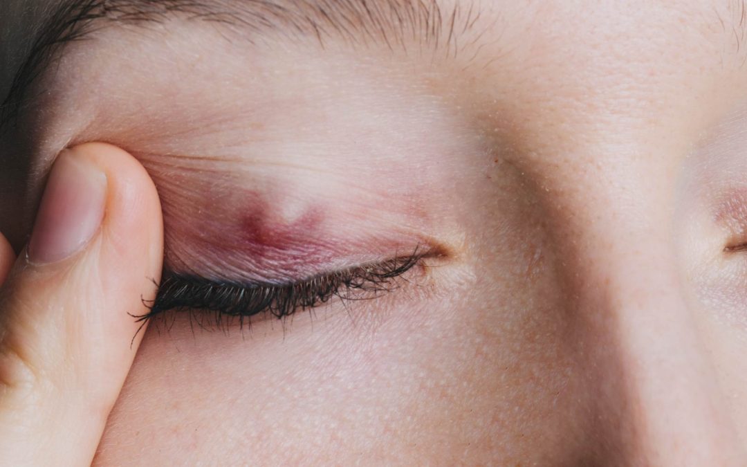 Chalazion: What is it?