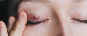 closed eyelid with chalazion